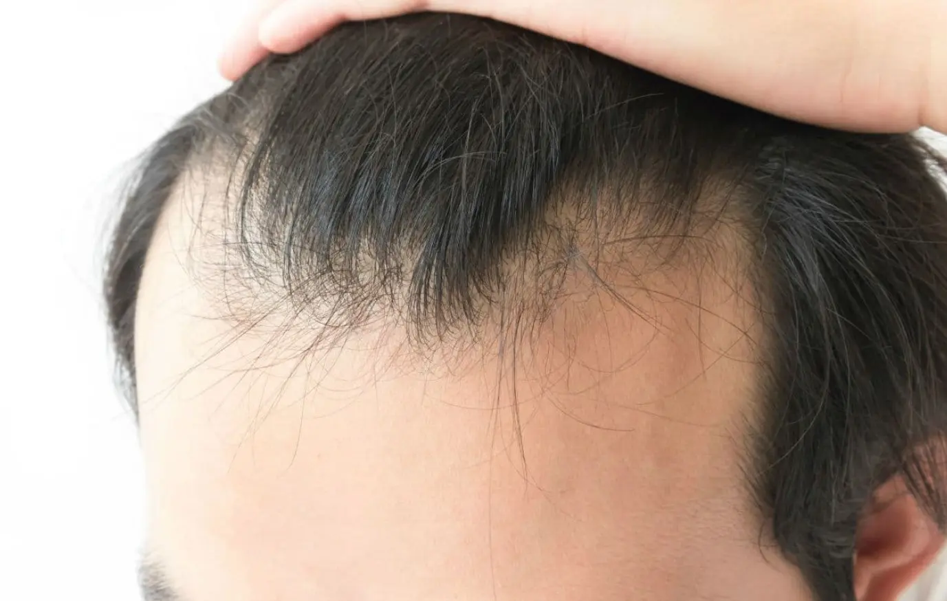 Alopecia masculina, un mal muy común