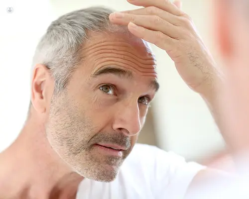 Alopecia tricofitica, consejos útiles para tratarla